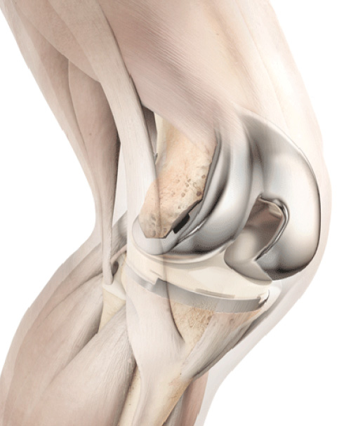 Remplazo de rodilla